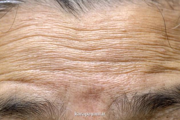 ابداع ماسک برای کاهش چین و چروک صورت