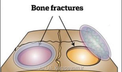 بانداژی كه شكستگی را درمان می كند
